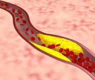 Nano 'drones' to target atherosclerosis