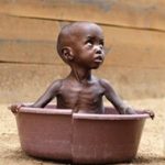 Malnutrition1