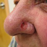 800px-Basal_cell_carcinoma2