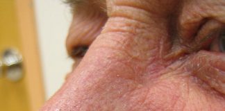 Five year efficacy of imiquimod in treating basal cell carcinoma