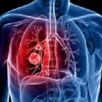 lung cancer