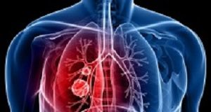 Late diagnosis by GPs link to lung cancer mortality — UK report lung cancer