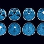MRI