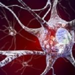 Parkinsons