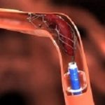 Thrombectomy