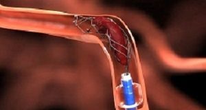 Clinical trial reveals potential for treating larger strokes with thrombectomy Thrombectomy