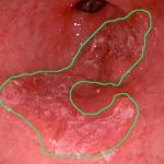 mb-115 oesophegal cancer