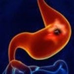 StomachUlcerWEB