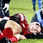 concussion