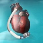lvad