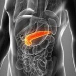 PancreaticCancer