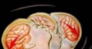 Serum test to identify abusive head trauma in infants EdInfantHeadTrauma