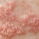 EdPickUrticaria