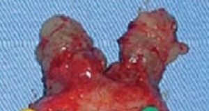 New research is driving down unnecessary prostate biopsies TPProstate