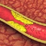 MUSTREADAtherosclerosis