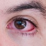 MustReadConjunctivitis