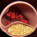 CoronaryHeartDisease