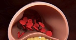 New early warning test for coronary artery disease CoronaryHeartDisease