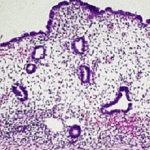 Endometriosis