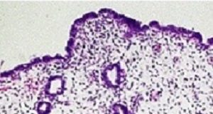 NICE guidelines on endometriosis: Diagnosis will improve, treatment won't Endometriosis