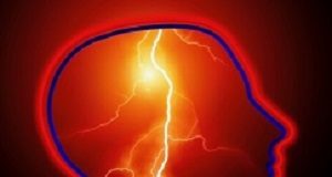 Life-saving ischaemic stroke treatment rarely used Stroke