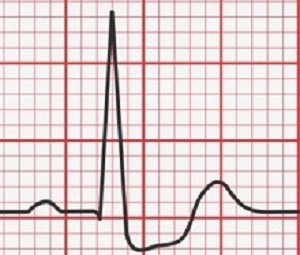 ECGDepression