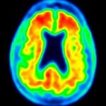 Alzheimers