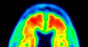 New charting tool to predict risk of Alzheimer's Alzheimers