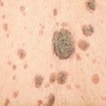 Metastatic