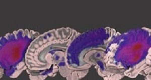 ATLAS: Large open-source data set of brain scans from stroke victims ATLAS