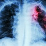 Tuberculosis
