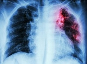 Tuberculosis