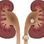 Kidneystones