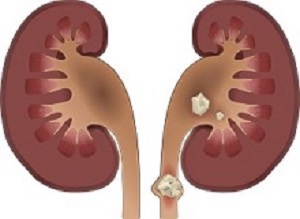 Kidneystones