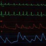 AtrialFibrillation
