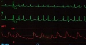 Noise levels link to increased incidence of atrial fibrillation AtrialFibrillation