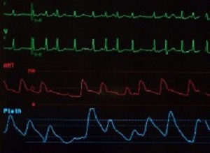 AtrialFibrillation