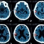 Intracerebral