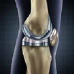 Kneereplacement