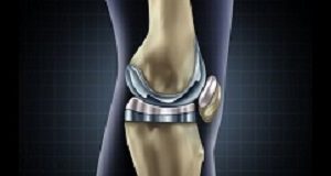 Partial knee replacement often better and cheaper alternative Kneereplacement