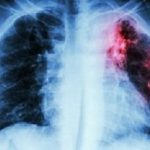Pulmonary