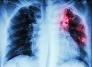 Pulmonary