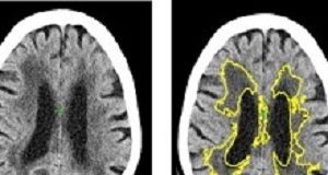 New software detects on a CT one of the commonest causes of stroke brainscans