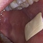 Mouthulcer