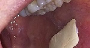 Plaster for the treatment of painful recurring mouth ulcers Mouthulcer