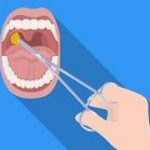 Tonsils