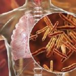 Tuberculosis