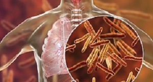 SA makes history with 'bold' move on DR-TB drug Tuberculosis