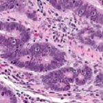 Tumour
