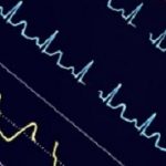 Colorful ECG waves on the hospital monitor